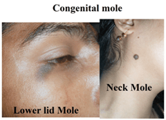 Congenital mole