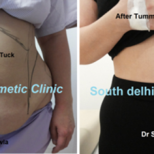 Before after tummy tuck surgery