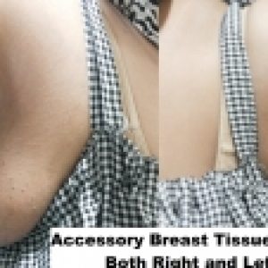 What Is Underarm Accessory Breast Tissue Or Breast Tail In Women