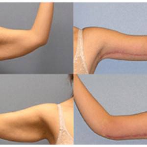 Arm Shaping Brachioplast Surgery