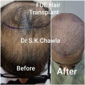 Delh iFue Hair Transplant