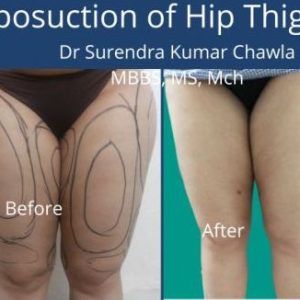 thigh liposuction