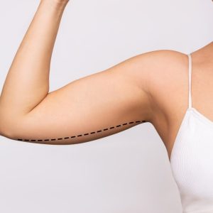 Arm lift surgery in delhi