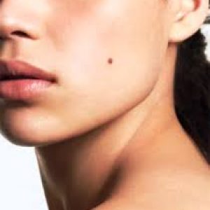 Mole Removal
