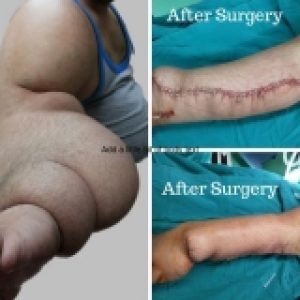 bulky arm treatment