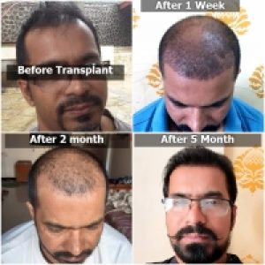 Hair Transplantation