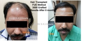 before after Hair Transplant