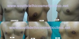Man Breast Reduction Surgery before after