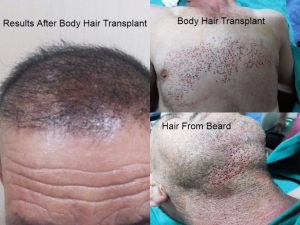 Body Hair Transplant