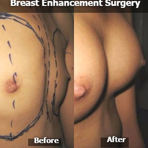 Breast Enhancement Before-After