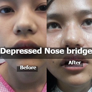 Depressed Nose Bridge Surgery
