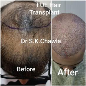 Hair-Transplant-surgery