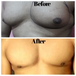 Male Breast removal
