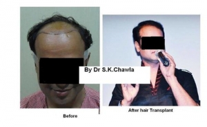 hair transplant before after        